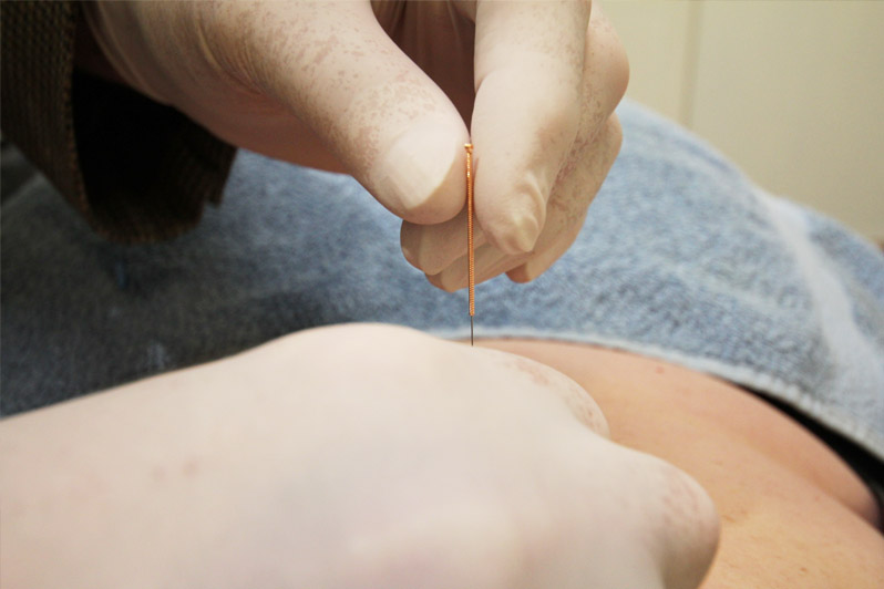 Dry needling closeup